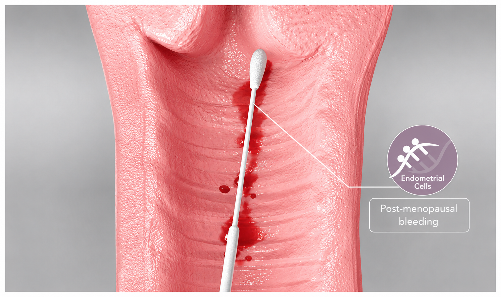 Post-menopausal Bleeding