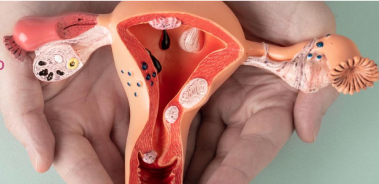 Uterine Fibroids